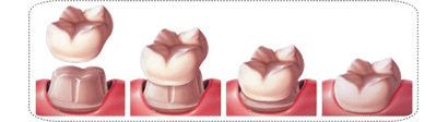 dental crown phuket