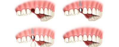 Immediate dental implants