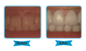 Whitening